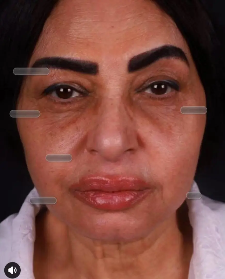 ​تصدرت الفنانة سلوى خطاب قائمة الأكثر بحثاً عبر محرك البحث «جوجل» ومنصات التواصل الاجتماعي خلال الساعات الماضية، وذلك عقب انتشار أحدث صور لها أثارت تفاعلاً واسعاً واهتماماً كبيراً من الجمهور، نظرًا لظهورها بملامح مختلفة وبدت أكثر شباباً ورشاقة عما اعتاد عليه المتابعون.