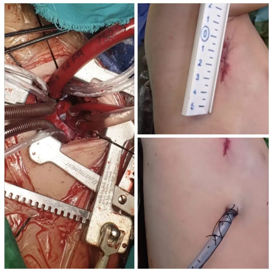 لأول مرة بصعيد مصر.. نجاح إصلاح عيب خلقي بقلب طفل بتقنية التدخل المحدود بجامعة أسيوط
