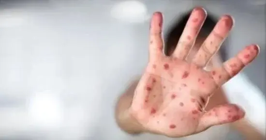 الصحة العالمية تحذر من استمرار انتشار جدري القرود وتقييم المخاطر عالميًا