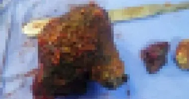 عملية نادرة في قنا.. فريق طبي ينجح في استخراج حصوة ضخمة تزن ربع كيلو من كلية مريض