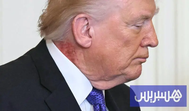 طبيب ترامب يكشف: علاج وقائي لطفح جلدي أحمر على رقبة الرئيس