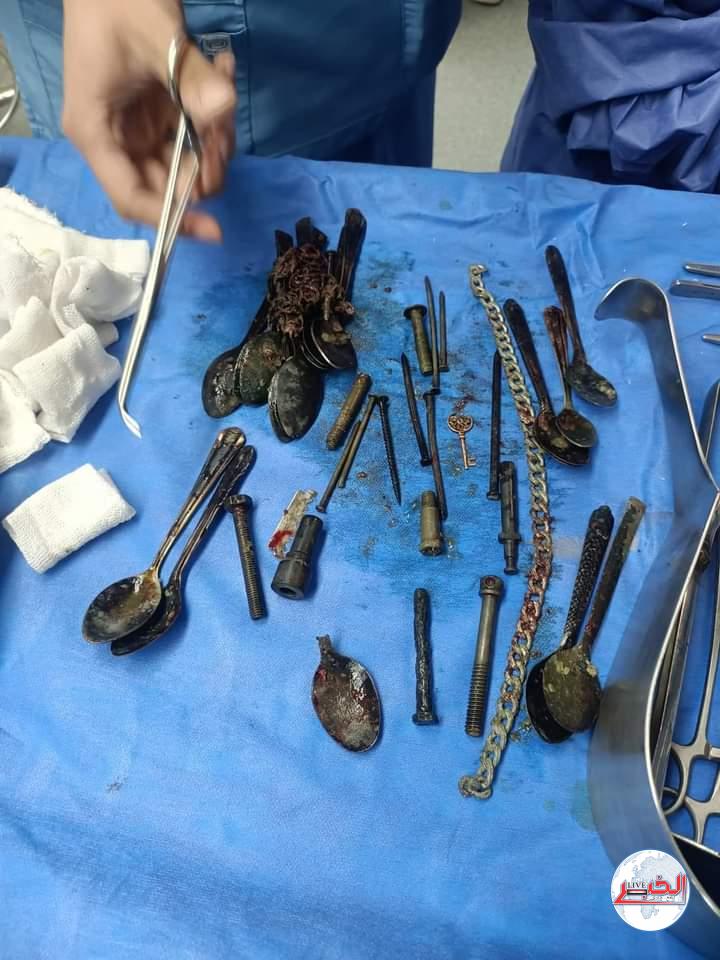ملاعق صغيرة وانسيال معدن ومسامير وموس حلاقة و ٢ بوجيه سيارة.. فى بطن مريض بالمنوفية!!