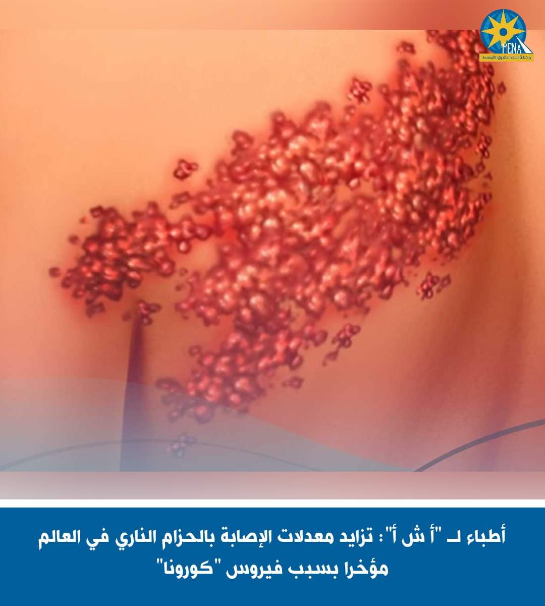  "كورونا" وراء تزايد معدلات الإصابة بالحزام النارى فى العالم مؤخرًا