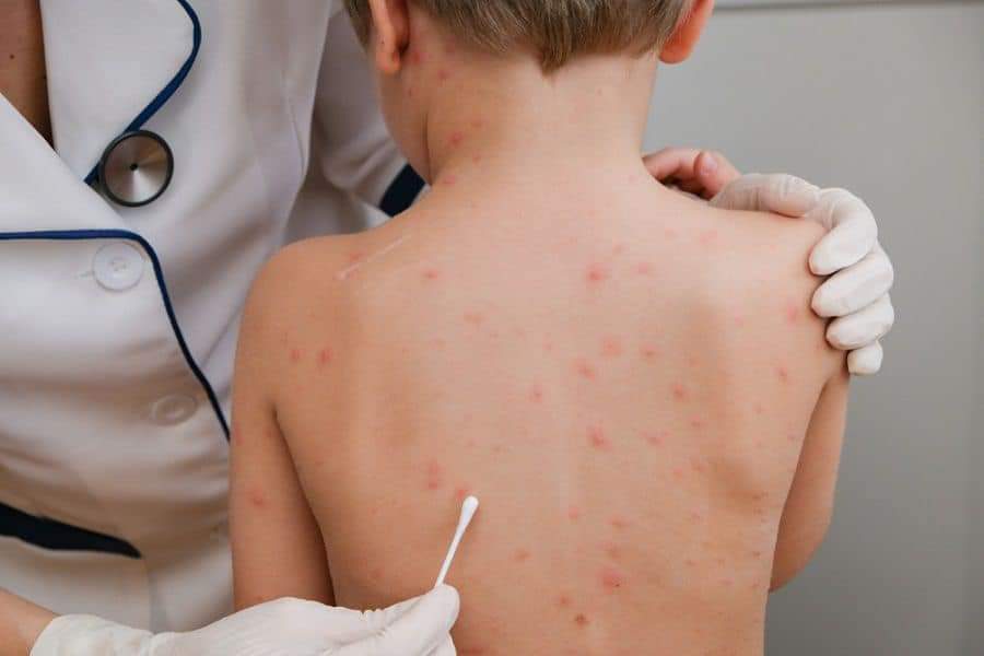 الصحة : لقاحات وعلاجات متاحة لجدرى القرود