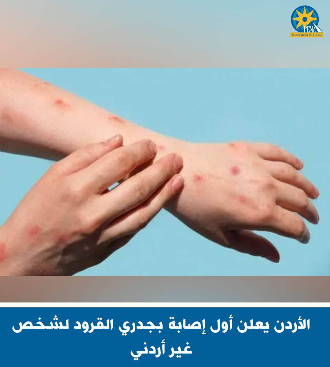 الأردن يعلن أول إصابة بجدرى القرود - الخبر لايف