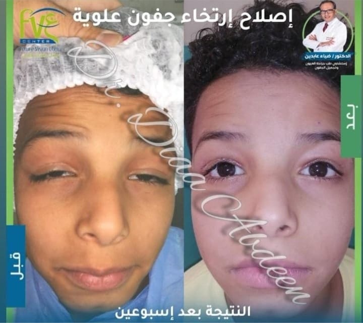ارتخاء الجفون وكسل العين خطر صامت يهدد الأطفال والكبار