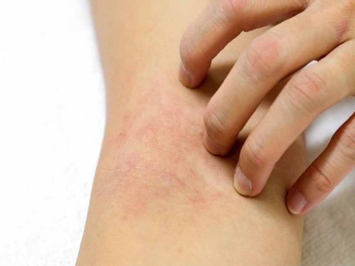 فريق بحثي أمريكي يتوصل لعلاج .. يحسن حالة مرضى سرطان الجلد المتقدم