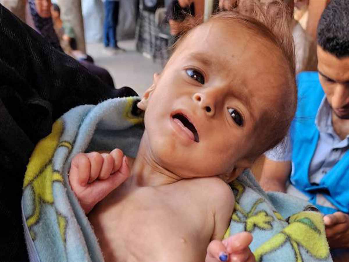 وفاة 21 طفلا في 3 أيام .. بسبب سوء التغذية والمجاعة في غزة