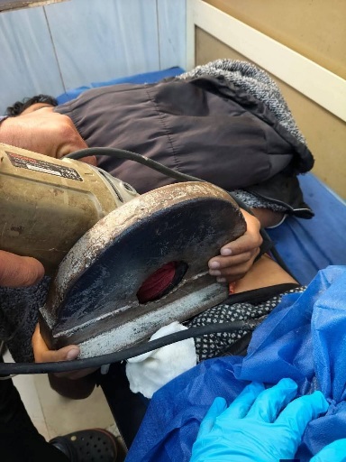 جراحة دقيقة بمستشفى جامعة الأزهر بدمياط لاستخراج منشار كهربائي من بطن طفل